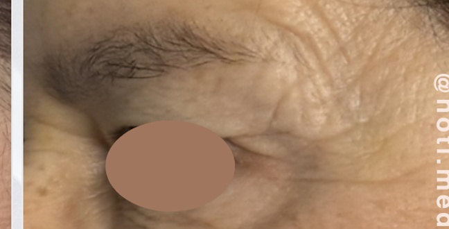 After wrinkle relaxer treatment for crow’s feet