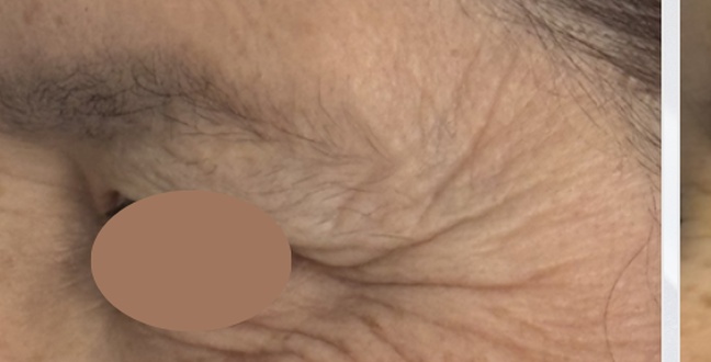 Before wrinkle relaxer treatment for crow’s feet