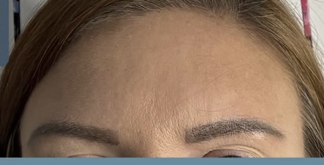 After wrinkle relaxer treatment for frown lines