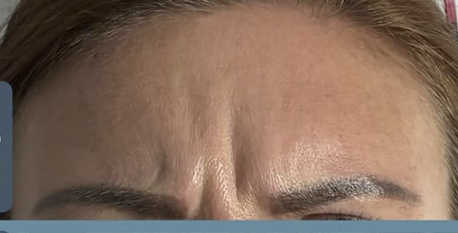 Before wrinkle relaxer treatment for frown lines